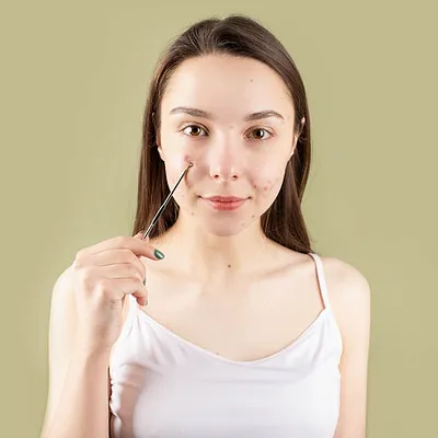 Pigmentvlekken na acne: zo verminder je donkere vlekjes