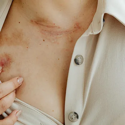 Waarom mogen littekens niet in de zon? Dit moet je weten