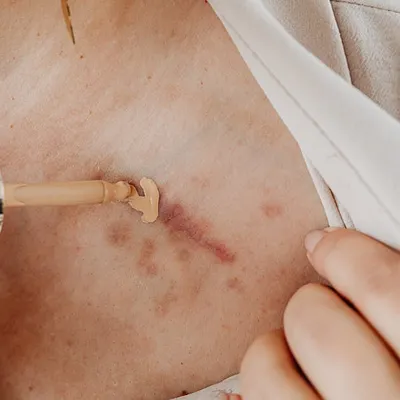 Littekens weg krijgen: 8 tips die echt verschil maken