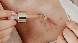 Littekens weg krijgen: 8 tips die echt verschil maken