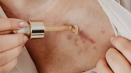 Littekens weg krijgen: 8 tips die echt verschil maken