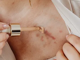 Littekens weg krijgen: 8 tips die echt verschil maken